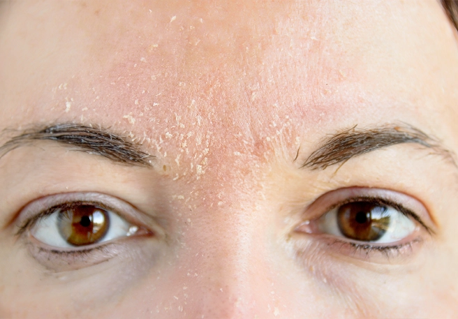 كل ما تحتاجين إلى معرفته عن التهاب البشرة